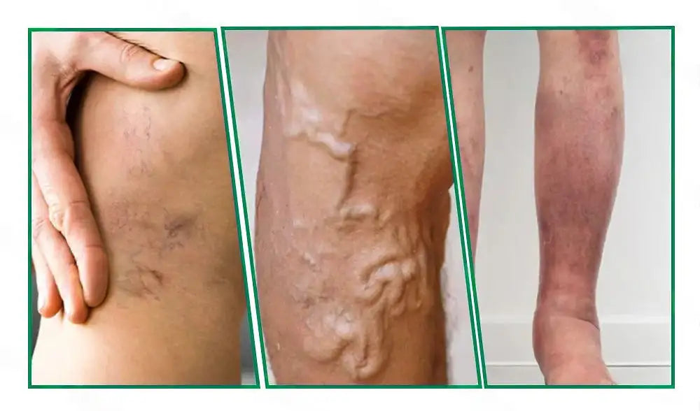 🦵🦵🦵Clearena® VeinTarget Microneedle Patch —— Once Daily, Visible Results in 7 Days