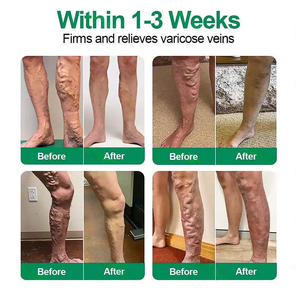 🦵🦵🦵Clearena® VeinTarget Microneedle Patch —— Once Daily, Visible Results in 7 Days