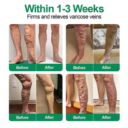 🦵🦵🦵Clearena® VeinTarget Microneedle Patch —— Once Daily, Visible Results in 7 Days