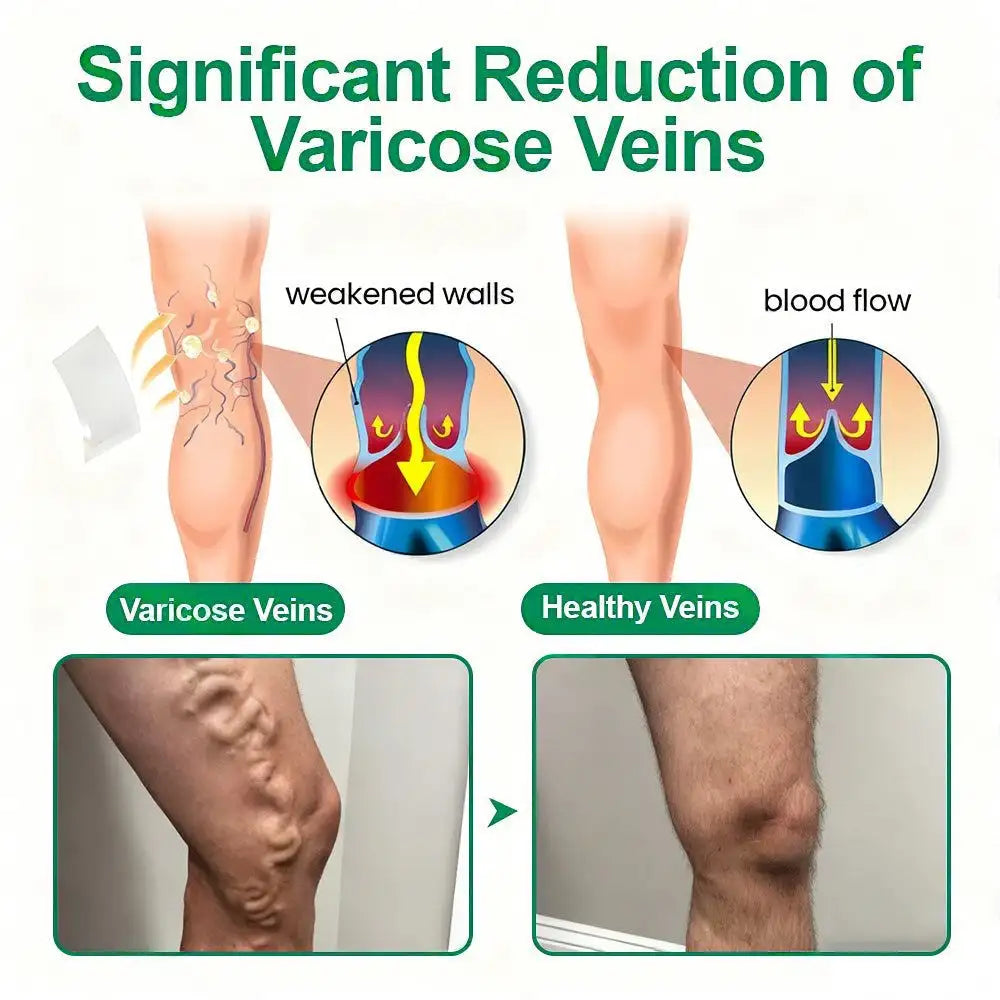 🦵🦵🦵Clearena® VeinTarget Microneedle Patch —— Once Daily, Visible Results in 7 Days